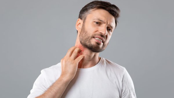 URTICARIA VA RATING.